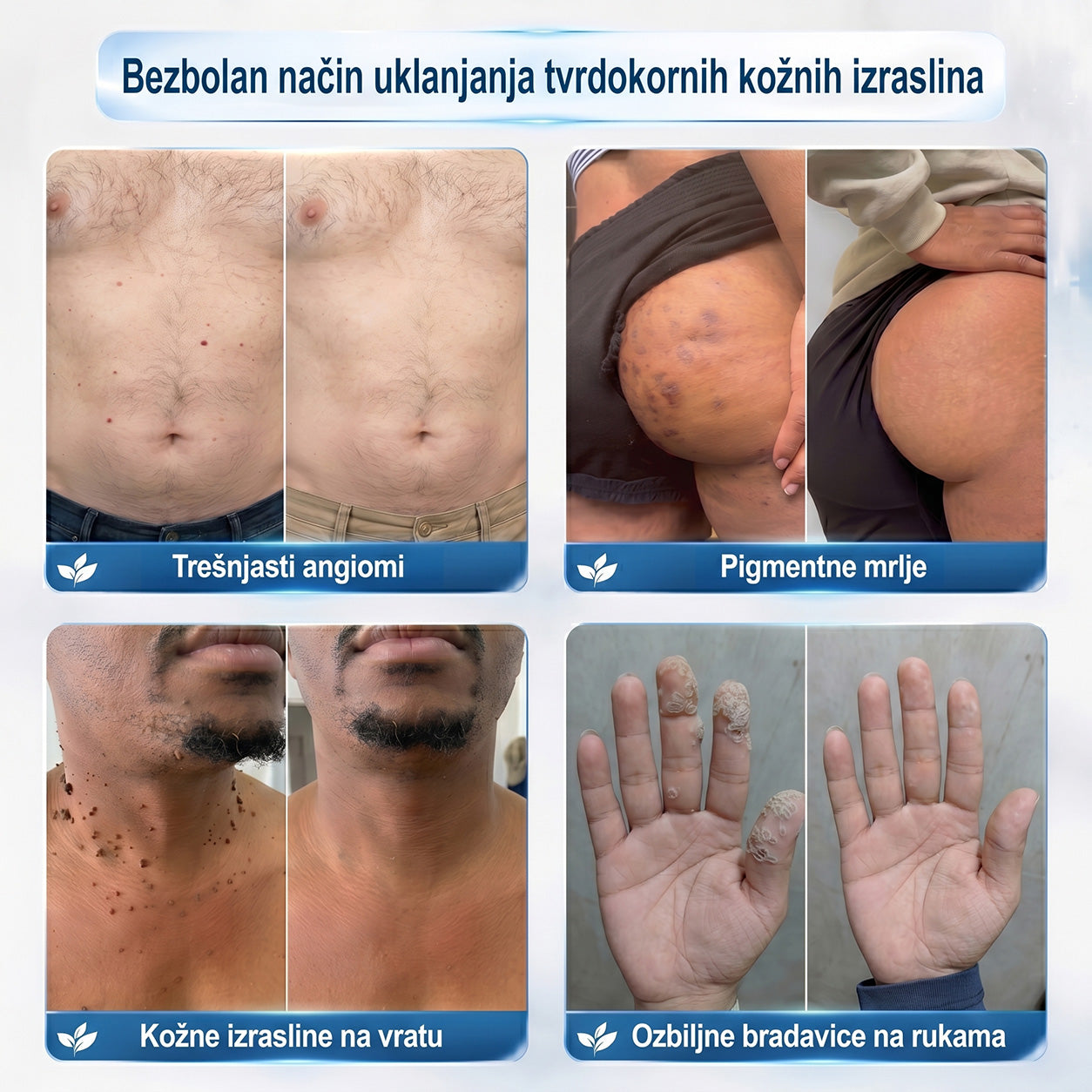 𝑱𝒆𝒅𝒊𝒏𝒂 𝒔𝒍𝒖ž𝒃𝒆𝒏𝒂 𝒕𝒓𝒈𝒐𝒗𝒊𝒏𝒂 🏆| 👩‍⚕️𝐏i𝐜𝐝o® 7 Dana Uklanjač mrlja i kožnih izraslina💗