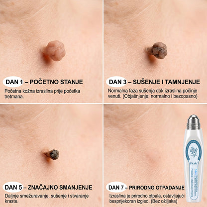 𝑱𝒆𝒅𝒊𝒏𝒂 𝒔𝒍𝒖ž𝒃𝒆𝒏𝒂 𝒕𝒓𝒈𝒐𝒗𝒊𝒏𝒂 🏆| 👩‍⚕️𝐏i𝐜𝐝o® 7 Dana Uklanjač mrlja i kožnih izraslina💗